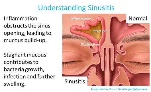 bacterial sinus infection