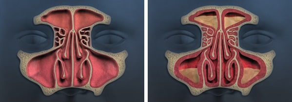 sinus normal vs abnormal 2