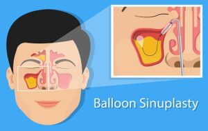 what is balloon sinuplasty 5d39c04b5e2a3